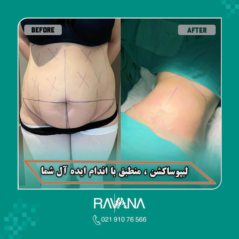 فیلم عمل جراحی شکم برای لاغری+فیلم و عکس پیکر تراشی بدون سانسور